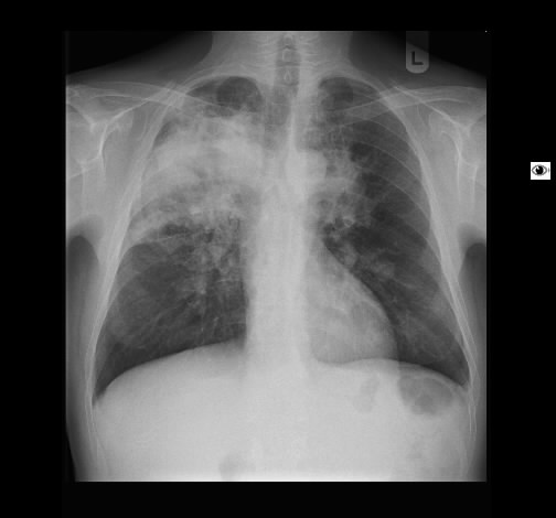 radiologisch fanden sich beidseits ausgedehntes zum teil nekrotisch